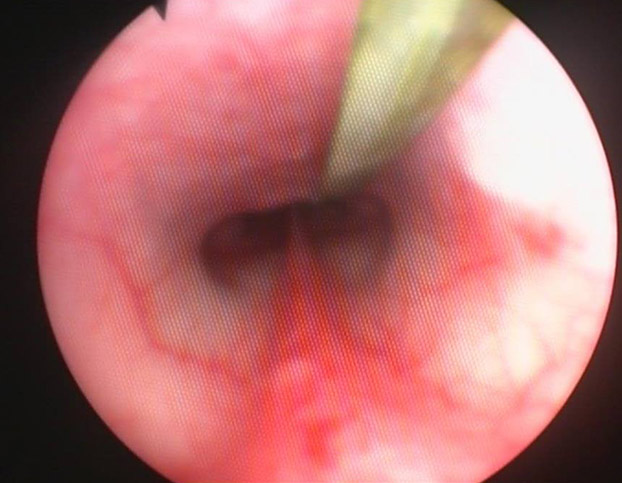 Blade of Grass in Nasopharynx of a Dog