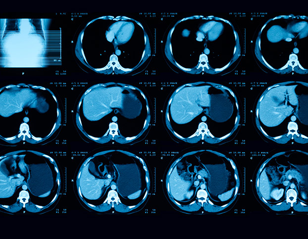 CT Scan